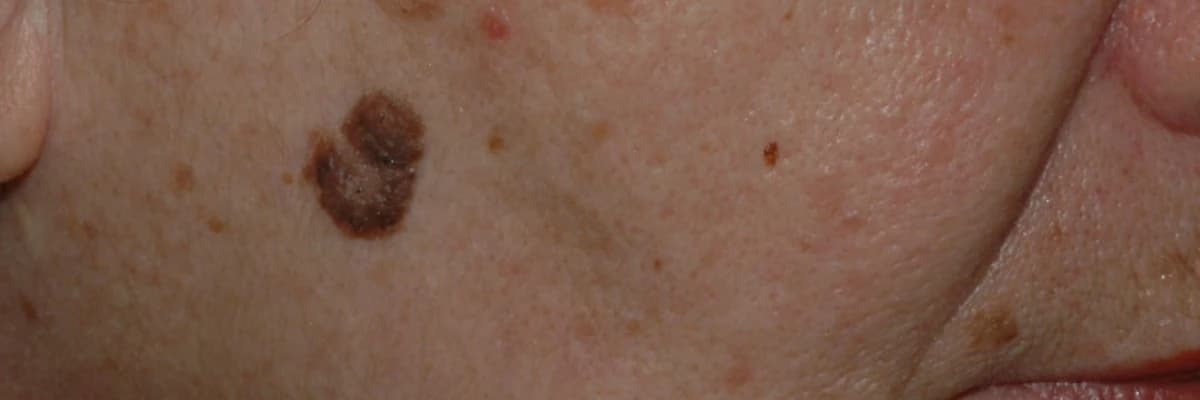 Malignant Melanoma