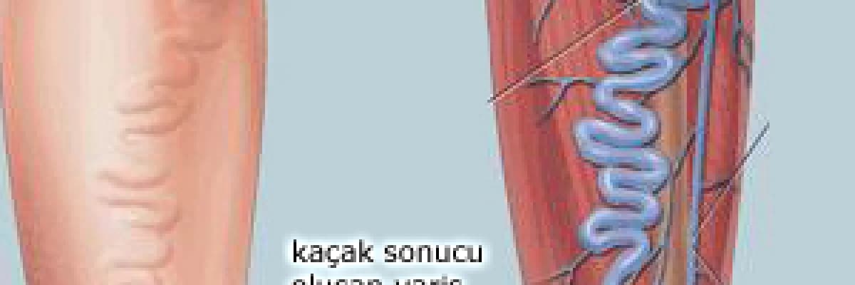 Varis tedavisinde kompleks bosaltıcı fizyoterapi