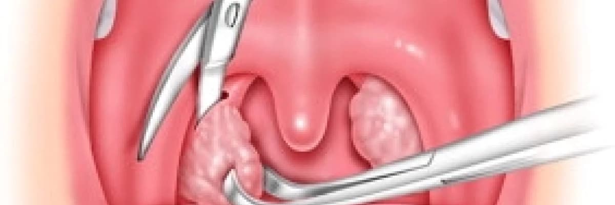Bademcikler ne zaman alınmalı?