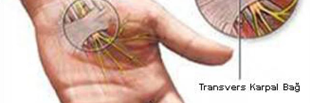 Karpal tünel sendromu teşhis ve tedavi yöntemleri