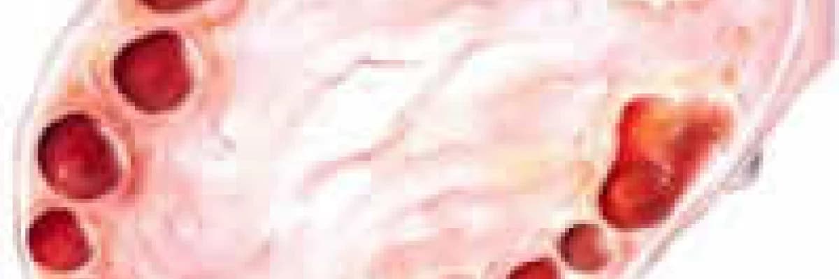 Polikistik over nedir? Neden olur?