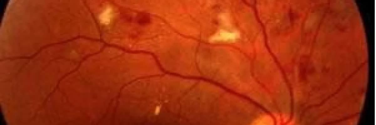 Şeker hastalığı gözü nasıl etkiler? (diabetik retinopati)