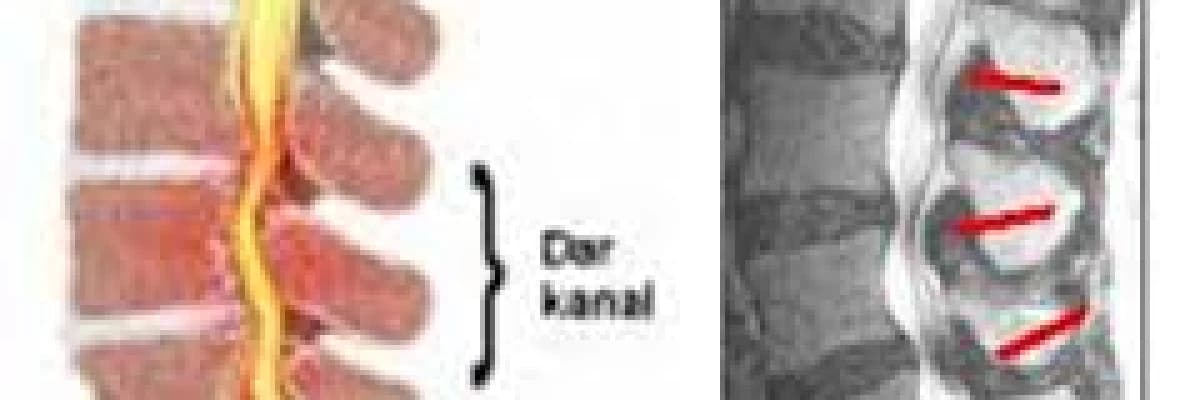 Omurilik kanalında daralma (spinal stenoz)