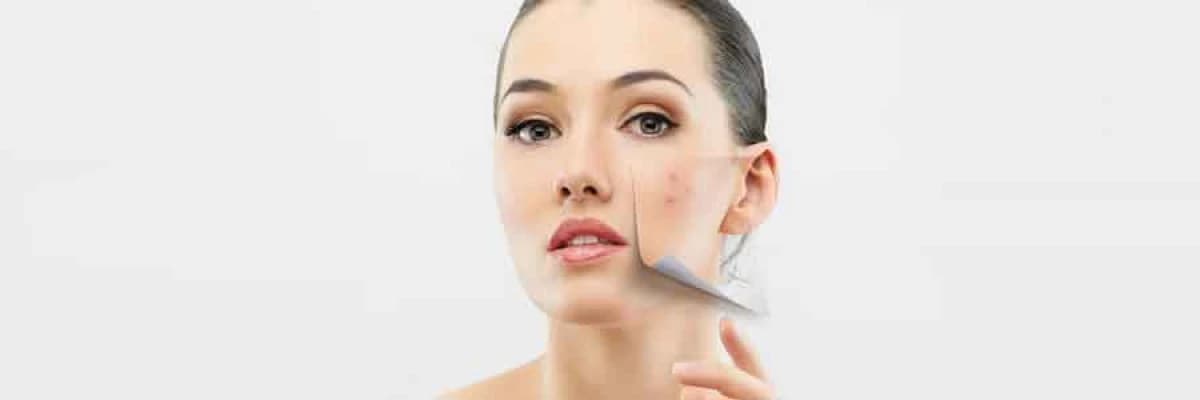 Dermabrazyon..