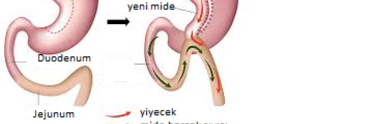 Laparoskopik gastrik by pass (mide by pass’ı)