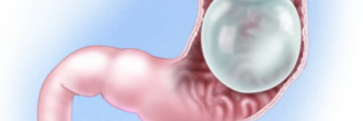 İntra gastrik balon nedir?