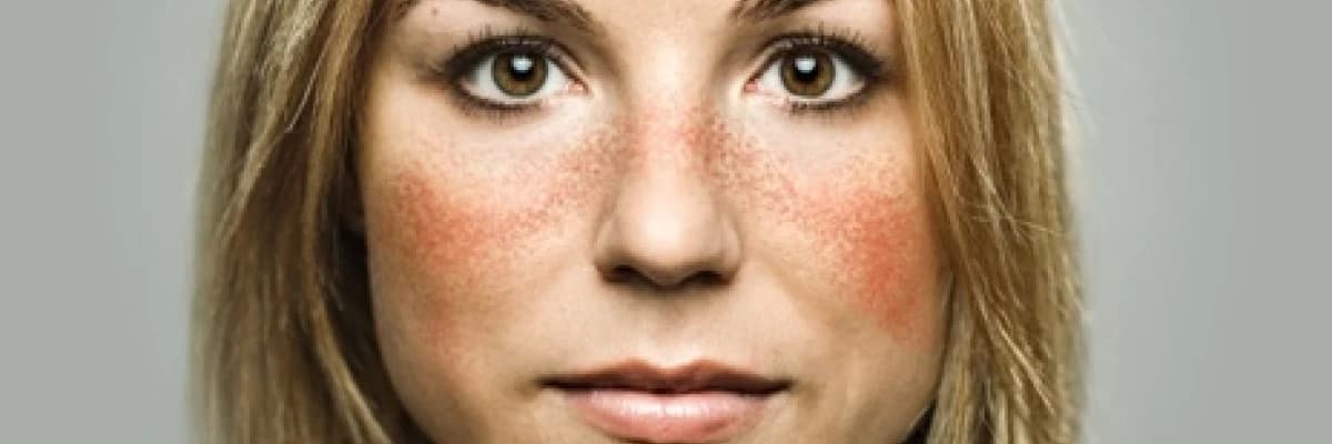 Lupus nedir?