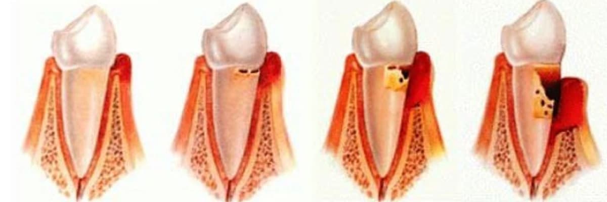 PERIODONTOLOJI
