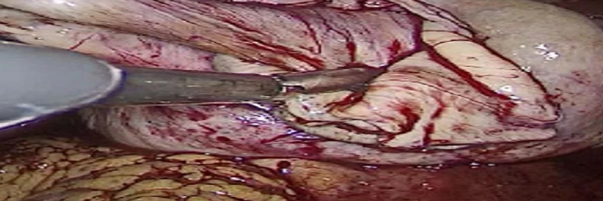 ÇAĞIMIZIN CERRAHİSİ: LAPAROSKOPİ