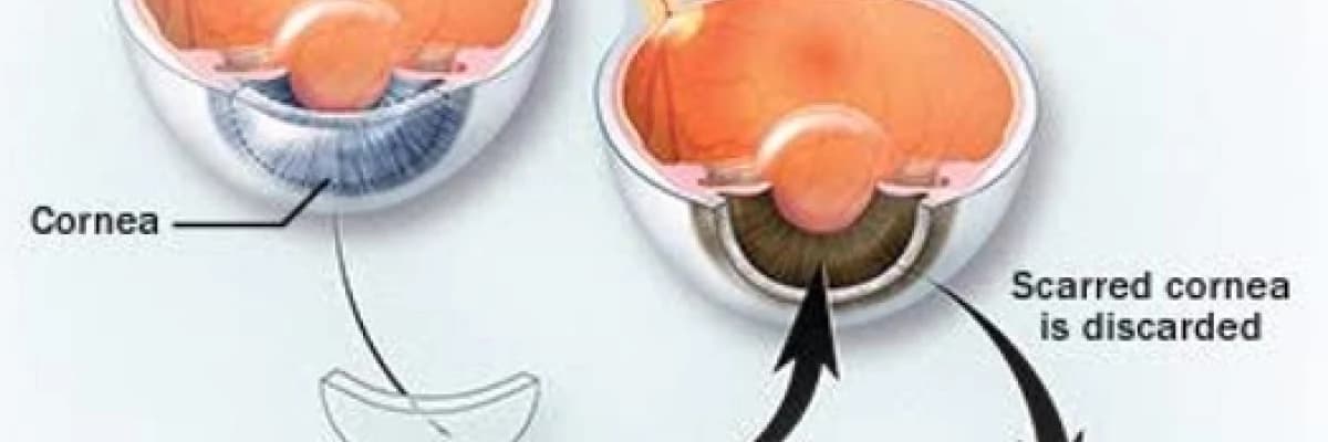 GÖZ TRANSPLANTASYONU NEDİR ?