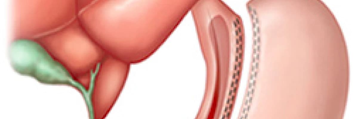 Gastrik Bypass