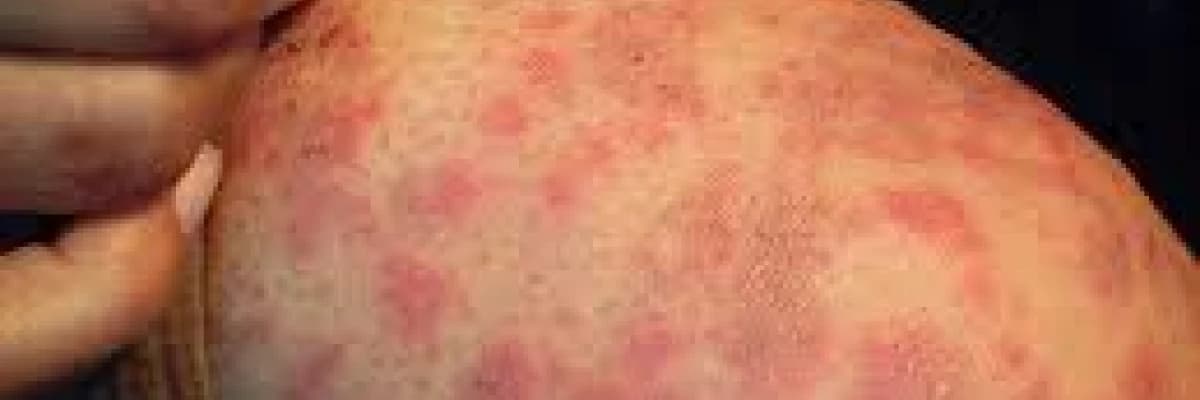 Biorezonans Metodu ile  Alerji Tedavisi