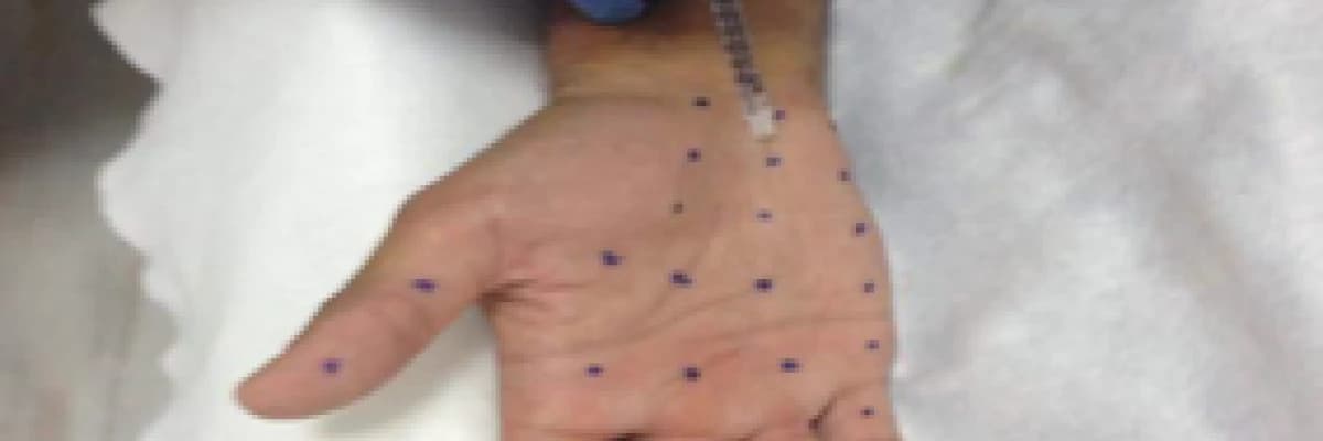 Aşırı Terlemede Botox Tedavisi!