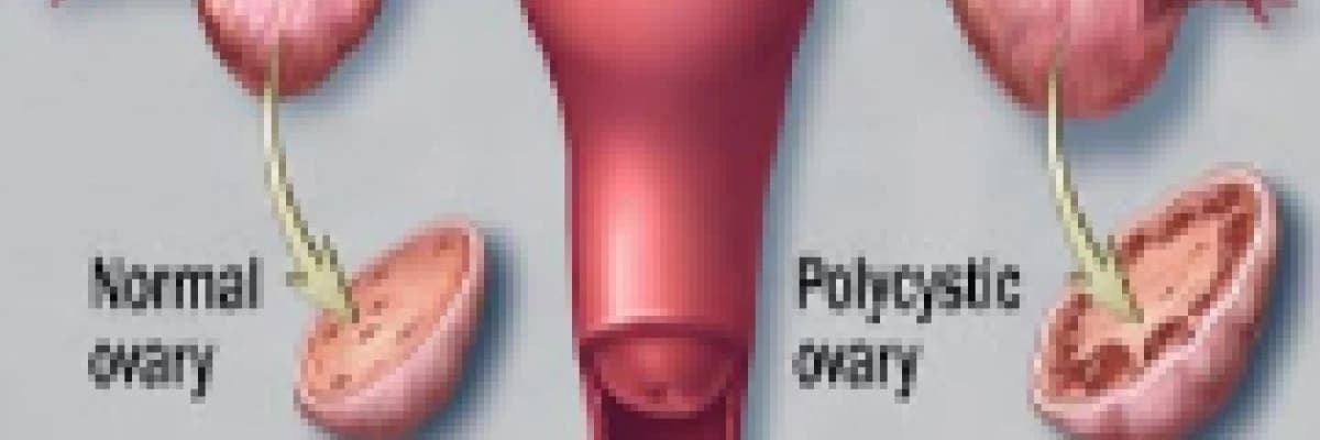 Polikistik over (yumurtalık) sendrom