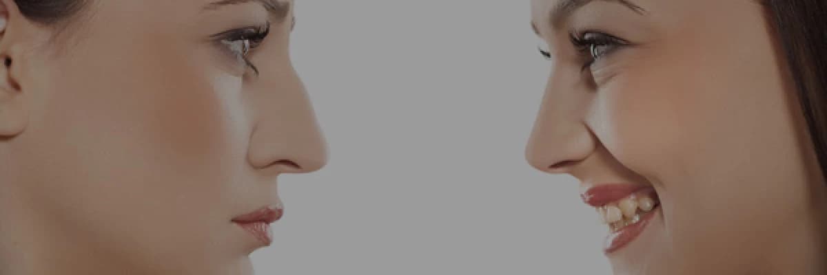 BURUN ESTETİĞİ (RHINOPLASTY) ve SIK SORULAN SORULAR