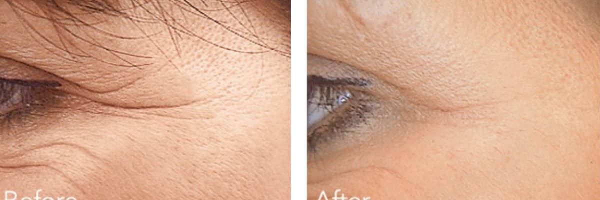 Botox nedir? Kimlere yapılabilir? Yan etkisi var mıdır? Ne zaman yapılmalıdır? Nerelere yapılabilir?