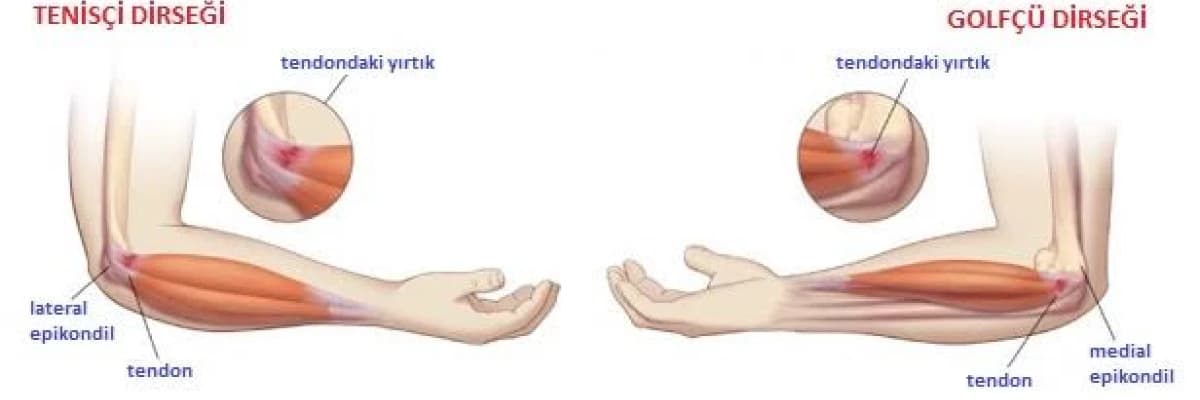 Dirsek; TENİSÇİ ve GOLFÇU DİRSEĞİ