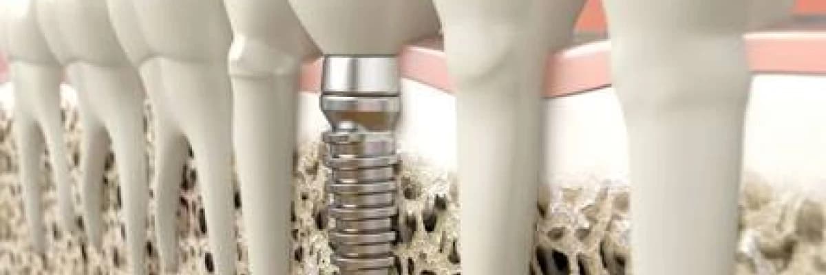 İmplant çürür mü , implant düşer mi ve implant konusunda daha fazla merak ettiğiniz tüm cevaplar