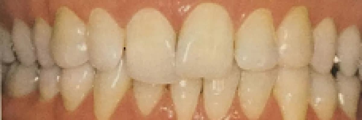 Dişeti çekilmeleri