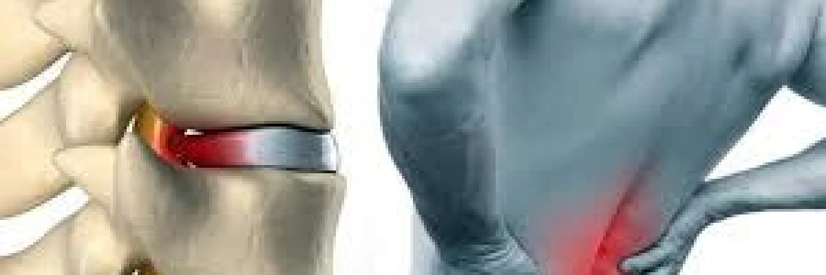 Bel Fıtığı Ve Tedavisi Hakkında