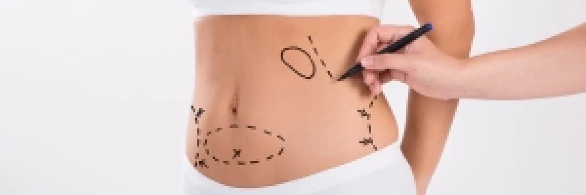 Karın germe veya Abdominoplasti
