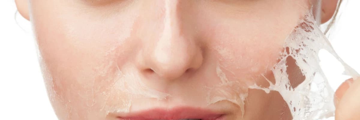 Kimyasal Peeling Nedir, Neden Yapılır ?