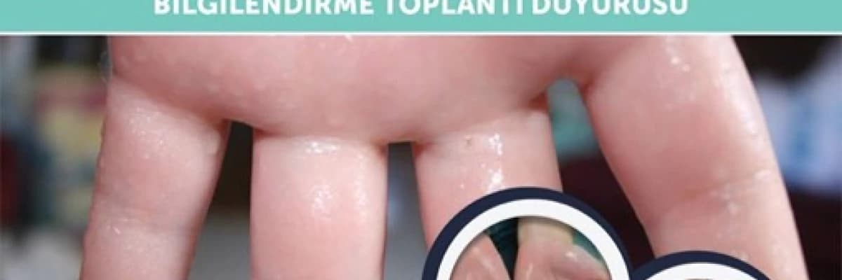 Aşırı el terlemesi