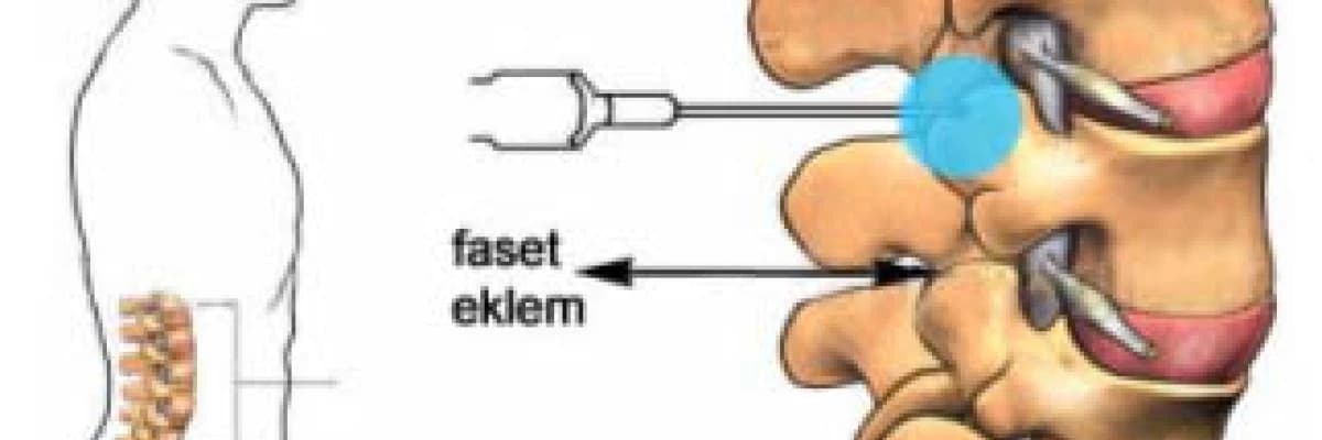 LAZER İLE KİREÇLENME (FASET ARTROZU/ SPONDİLOZ) TEDAVİSİ