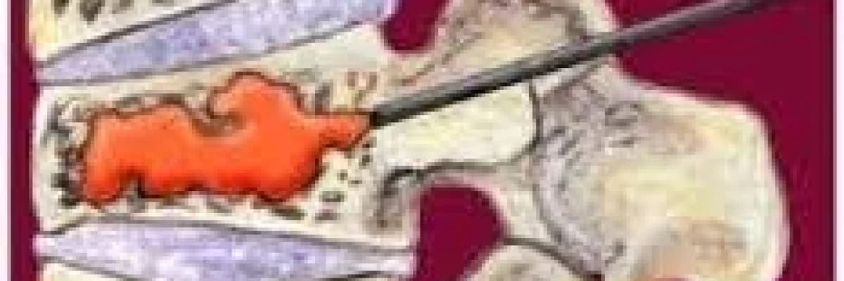 OMURGA KIRIKLARININ AMELİYATSIZ VE BIÇAKSIZ TEDAVİSİ