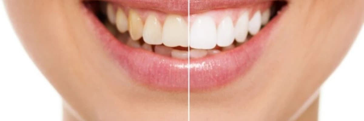 bleaching(ağartma)