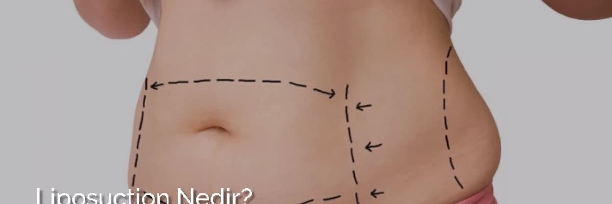 Liposuction ve Liposuction Olurken Bilinmesi Gerekenler!