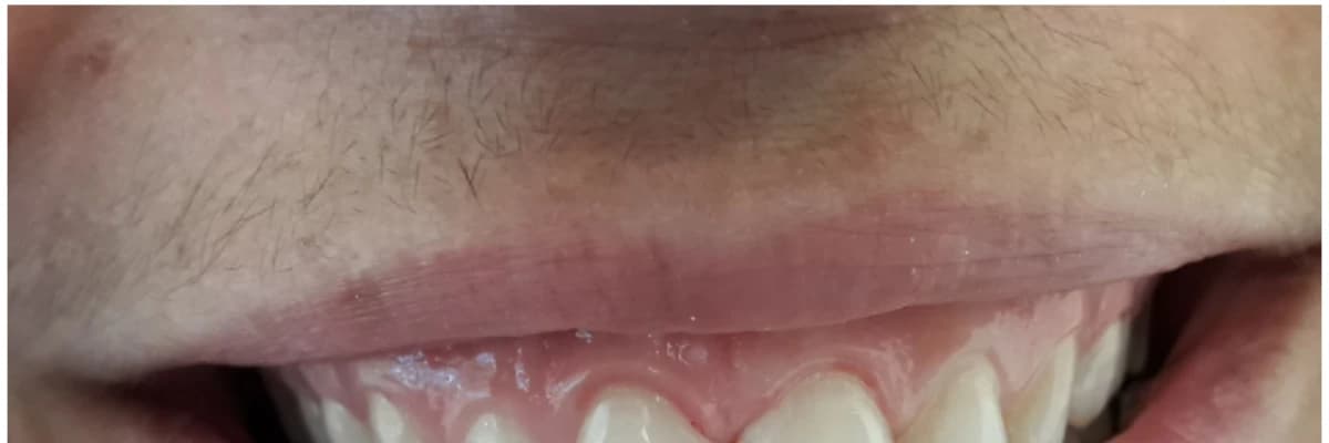 Diastema