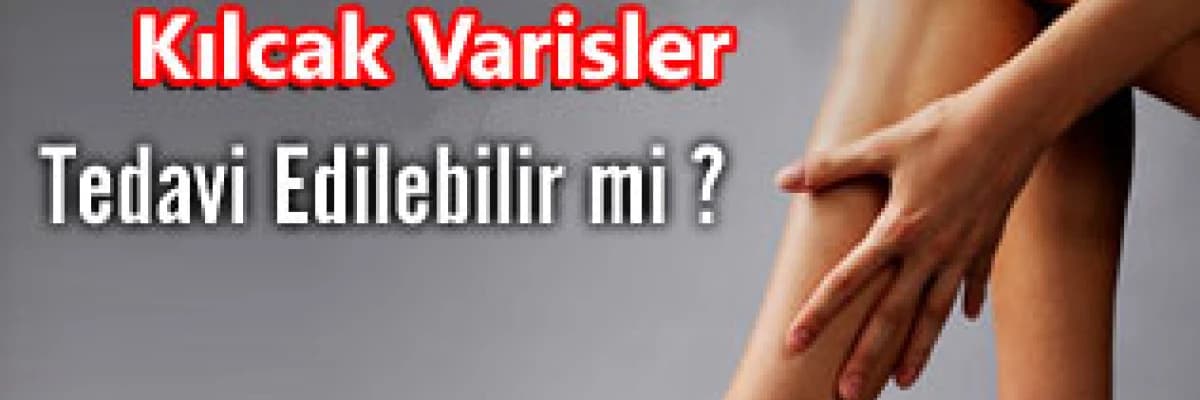 Kılcal varisler tedavi edilebilir mi?