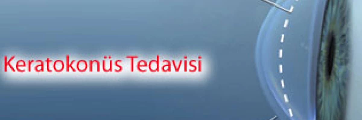 Keratokonüs tedavisi