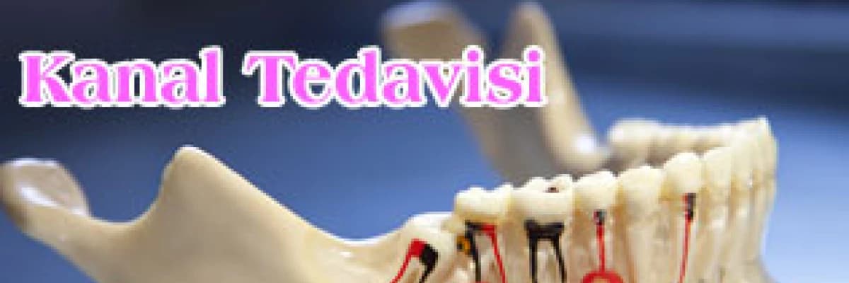 Kanal Tedavisi