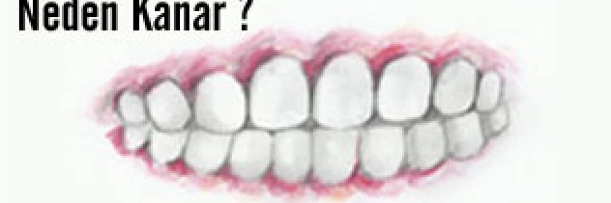 Dişetleri neden kanar?