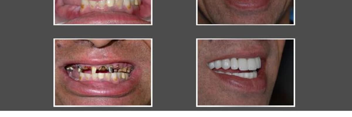 İmplant Nedir? İmplant Kimlere Uygulanır?