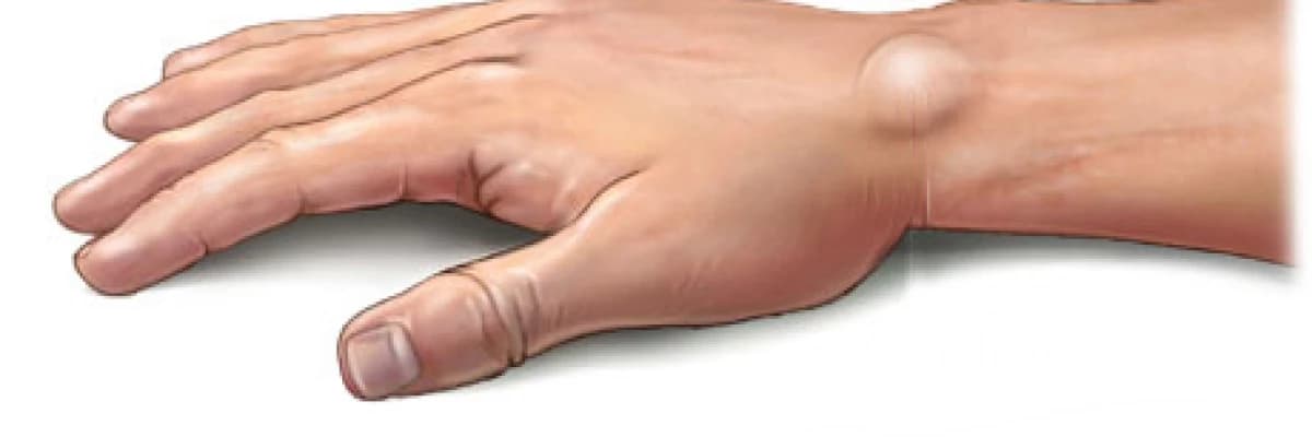 Ganglion nedir ?