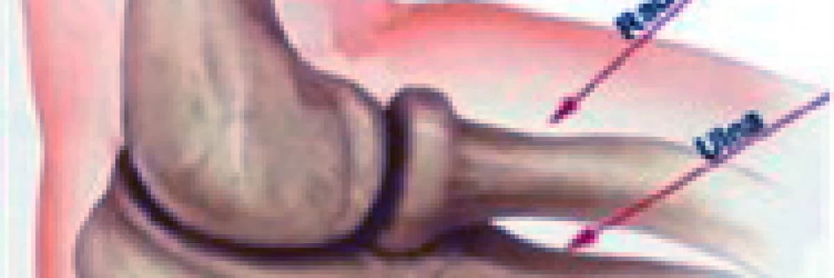 Tenisçi dirseği nedir? Şikayetleri nelerdir?