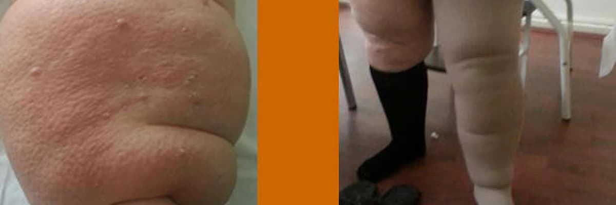 Kol ve Bacak şişmesi (lenfödem)