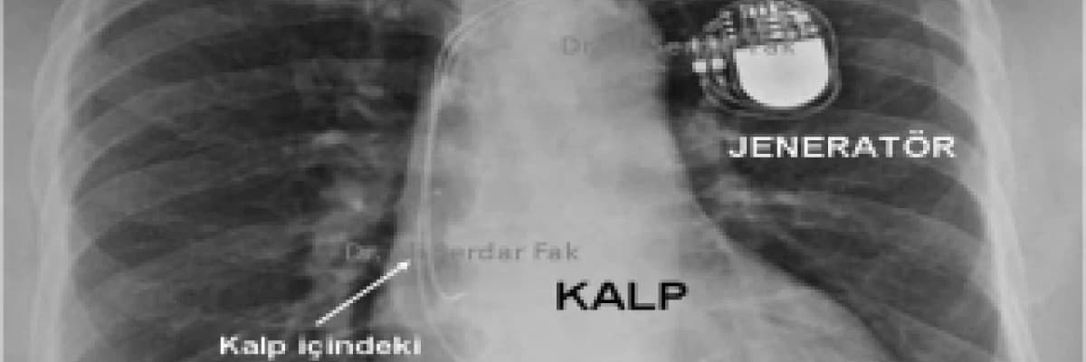 Kalp pilleri hakkında 1, kalp pili hastalarına öneriler