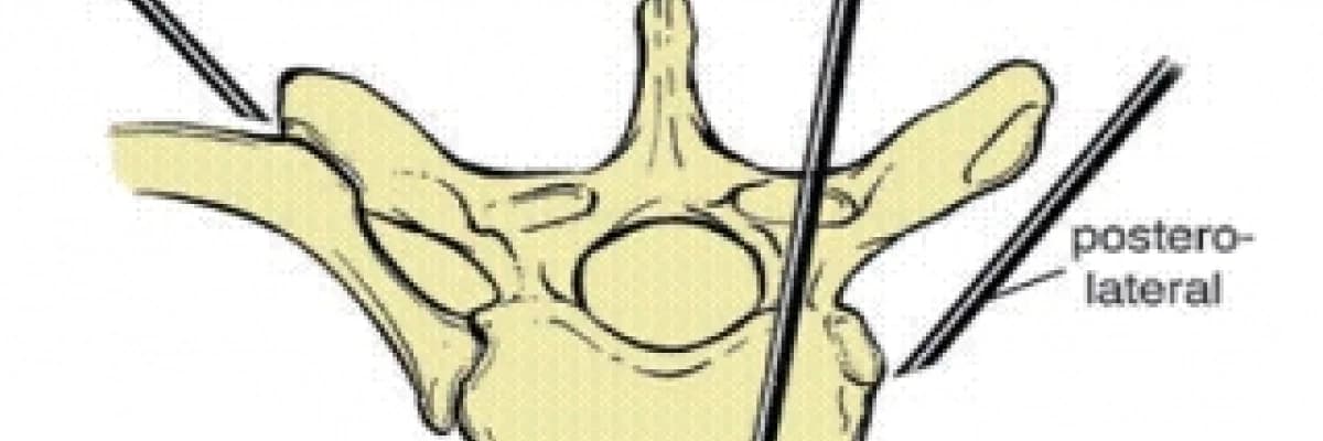 Omurga İğne Biyopsisi