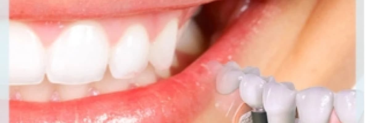 DİŞ EKSİKLİĞİ ve İMPLANT TEDAVİSİ