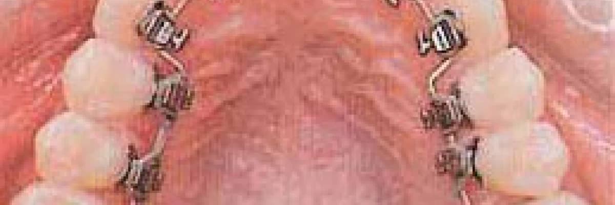 Estetik diş hekimliğinde gelişen Lingual teknik…