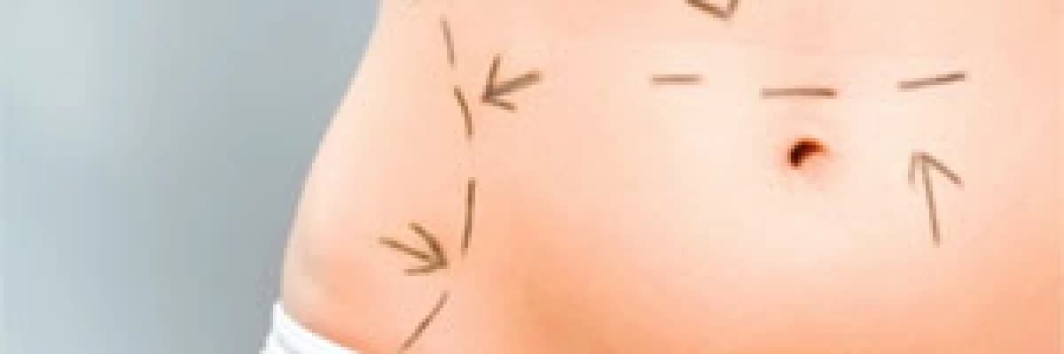Liposculpture, estetik cerrahinin insan bedenine sanatsal dokunuşudur