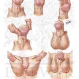 Hypospadias