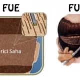 Fue yöntemi ile saç ekimi
