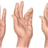 Dupuytren kontraktörü nedir?