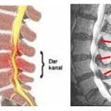 Omurilik kanalında daralma (spinal stenoz)