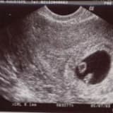 Ultrasonografi nedir,ne değildir?